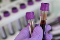 Comment ce nouveau test prétend dépister un cancer en moins de 10 minutes