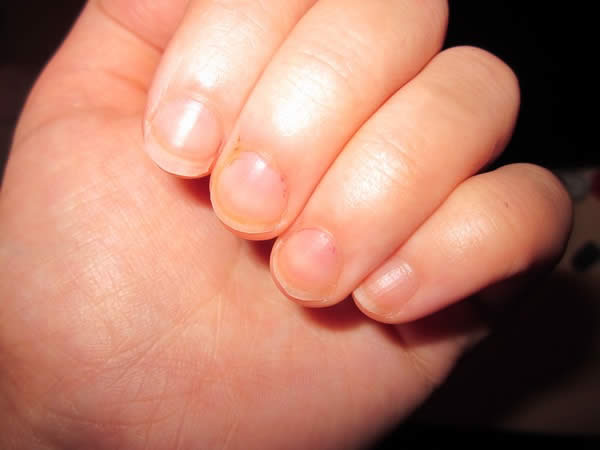 ongles