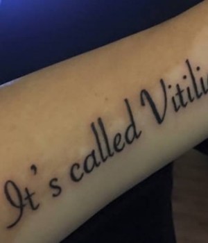 femme-vitiligo-tatouer