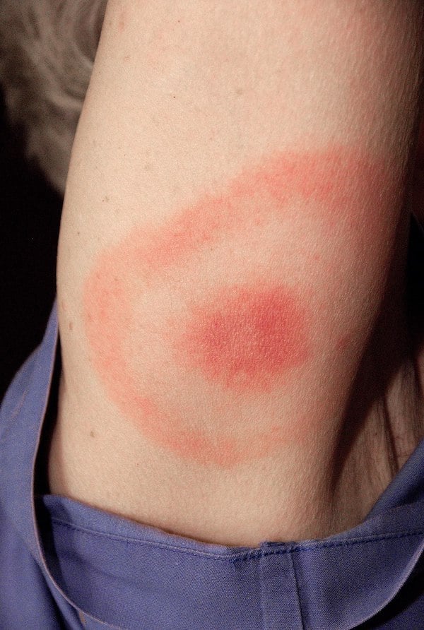 J’ai la maladie de Lyme, et ça me gâche la vie